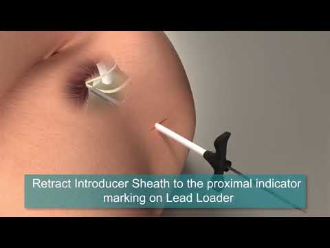 StimRouter Procedure Animation | Axillary Nerve