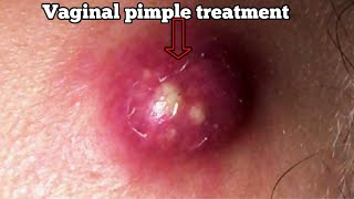 How to treat vaginal pimples and what are couse ,prevention and symptoms for vagina pimples at home
