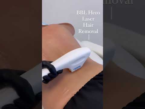 Laser Hair Removal with the BBL Hero Laser
