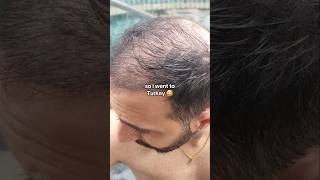 pov: you went to Turkey to get your hair back