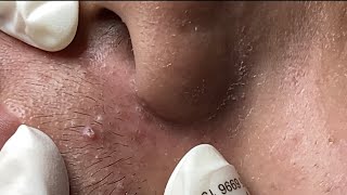 Blackhead & Whitehead Extractions #HoangMySpa191