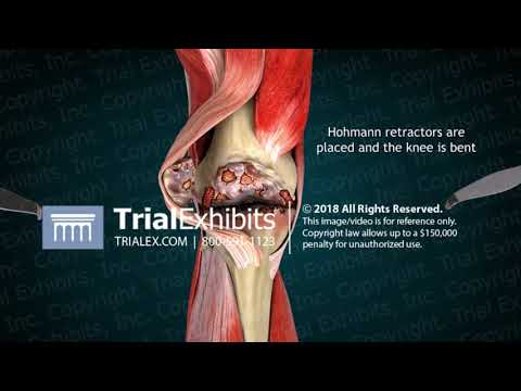 3D Animation of Right Total Knee Replacement