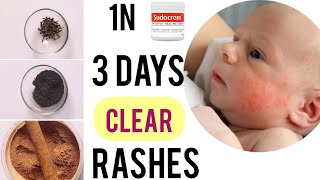 how to get rid of newborn rash on face |baby acne |get rid of baby rash|atopic dermatitis#babyrash