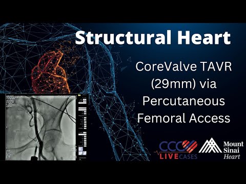 CoreValve TAVR (29mm) via Percutaneous Femoral Access - October 2014 Structural Live Case