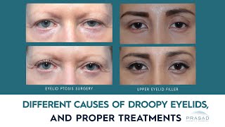 What can Cause the Eyelids to Appear Droopy, and Appropriate Treatments
