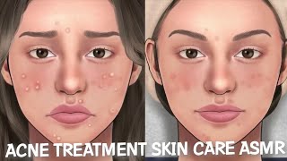 Acne Treatment skincare Asmr|Animation ASMR|#youtube #animation @smilebam_asmr