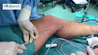 Liposucción Rodilla