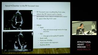 Right Ventricular Assessment: Move Over RV S’ & TAPSE, Strain all the Way – Prof Liza Thomas