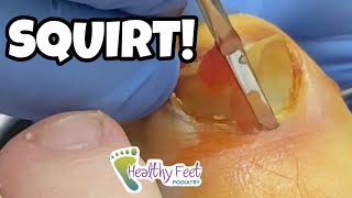 WATCH A TOE SQUIRT AFTER A BLISTER UNDER THE TOENAIL IS POPPED!