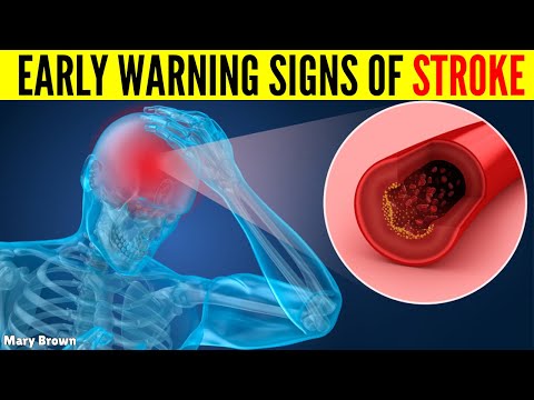 7 early warning signs of stroke everyone should know
