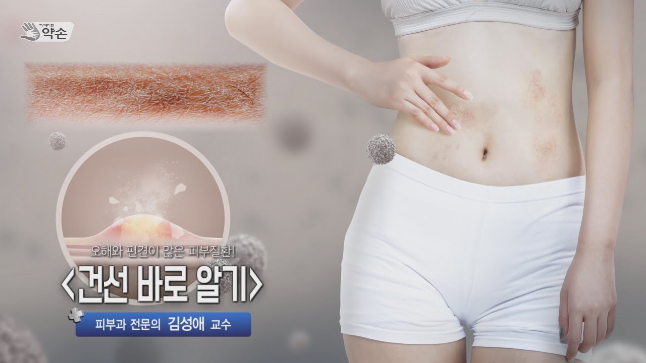 오해와 편견이 많은 피부질환! '건선 바로 알기' | 피부과 김성애 교수