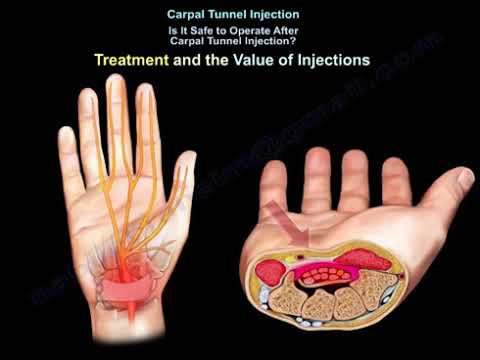 Carpal Tunnel Injection. Is Injection Helpful?