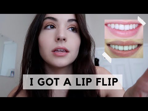 I GOT A LIP FLIP! (MY BOTOX EXPERIENCE) BEFORE + AFTER PICS