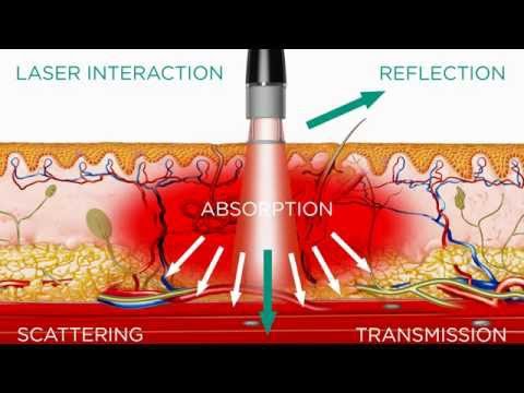 High Intensity Laser - Medical Effects