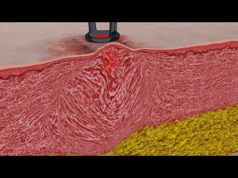 UltraPulse con SCAAR FX