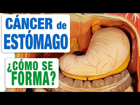 Stomach Cancer - How Does It Form?
