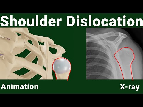 X-ray for posterior shoulder dislocation (animated)