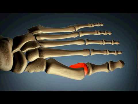 Hallux Valgus Nice | Chirurgie pied Nice | Docteur Becquet