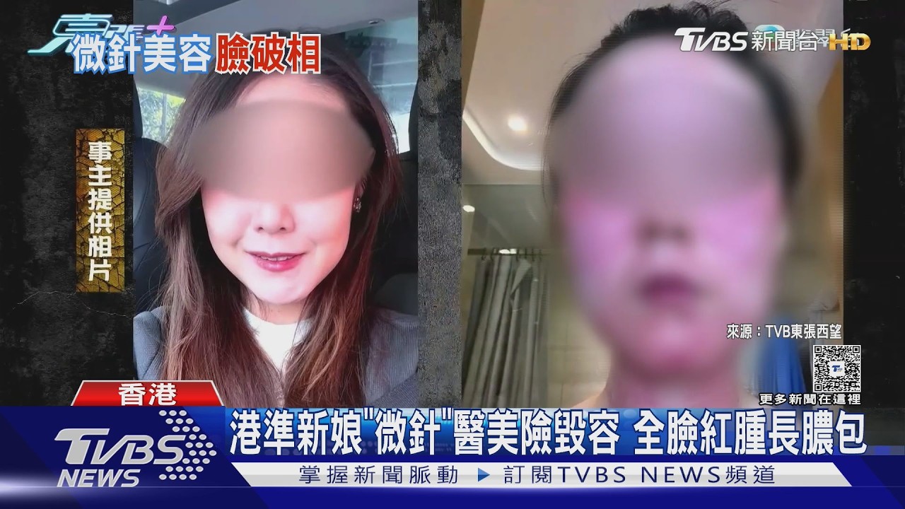 影音/準新娘赴日拍婚紗前做「微針」 整臉爆膿包幾近毀容