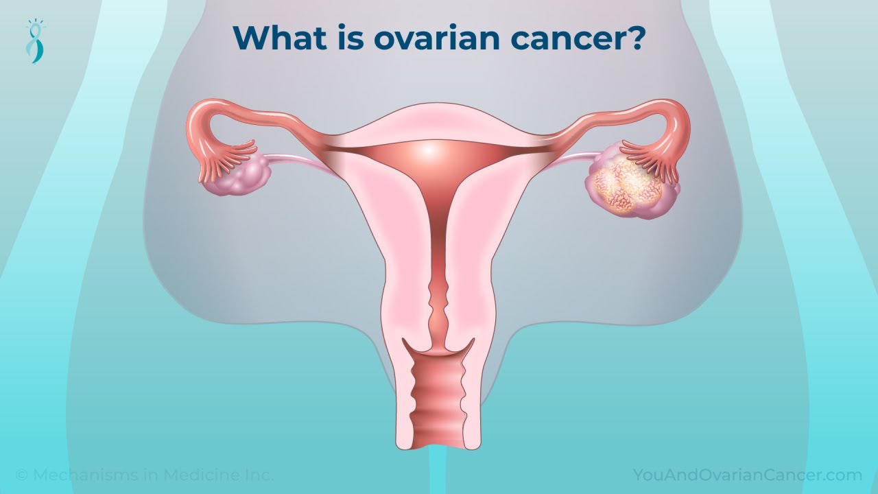 Understanding Ovarian Cancer