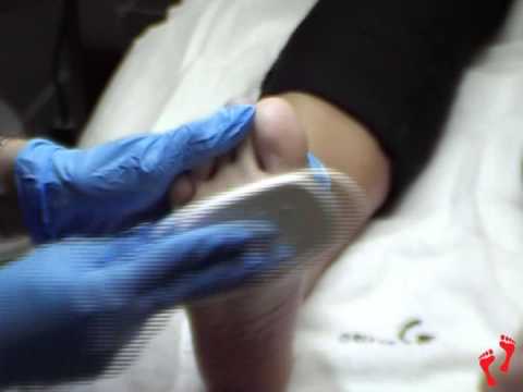 comment soulager durillon