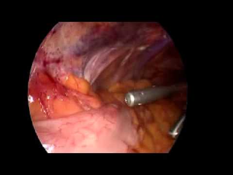 Transvaginal Nephrectomy - Instrument Dissection