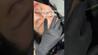 두피 문신 성형 시술