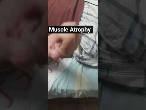 #Muscle Atrophy physiotherapy