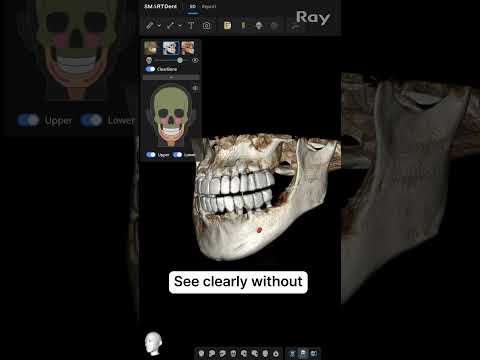 SMARTDent : 5D Tutorial #2-1. ClearBone : Metal Artifact Free
