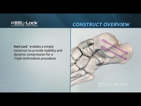 Keel-Lock™ Implant System - Triple Arthrodesis Surgical Technique Animation