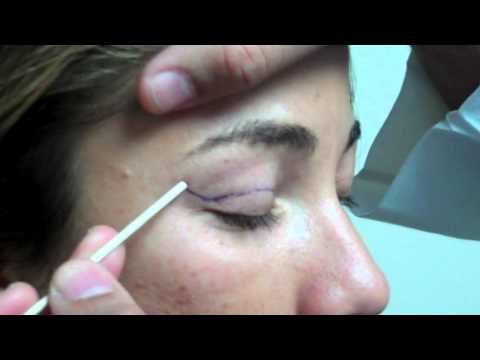 Dr. Jeffrey Epstein - Mark-Up for Upper Eyelid Blepharoplasty - Female Patient