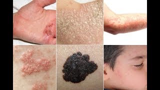 9 MALADIES DE LA PEAU EXPLIQUÉES , RECONNAÎTRE LES SYMPTÔMES
