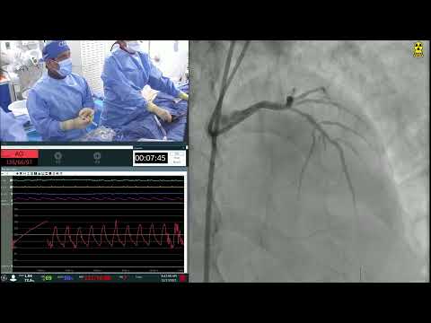 Live Relay - Imaging Guided Complex PCI of Calcified LM/LAD using Rotational Atherectomy and DES