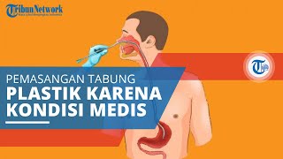 Nasogastric Tube, Pemasangan Tabung Plastik Tipis Melalui Lubang Hidung dan Berujung di Lambung
