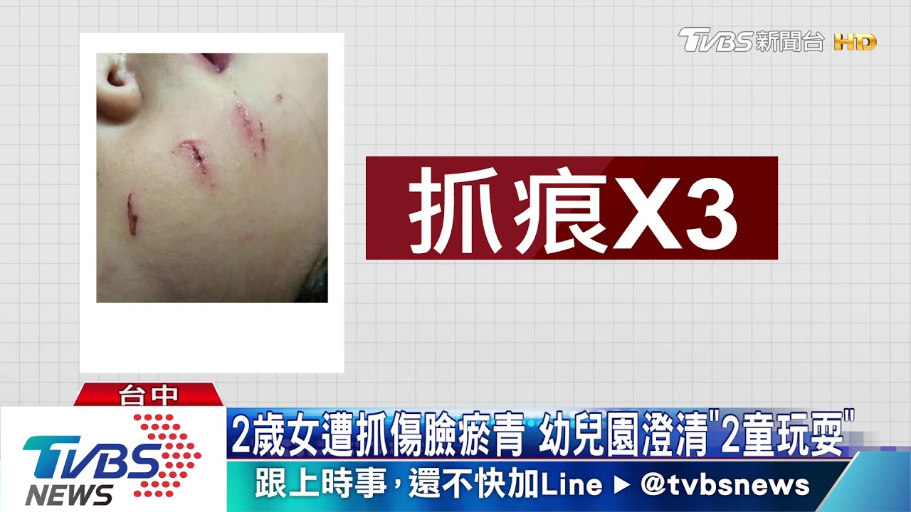 2歲女童幼兒園返家 臉被抓花園方澄清「玩耍」