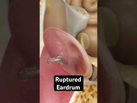 How does an eardrum rupture? (3D Animation)