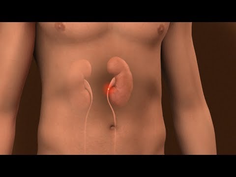 Mayo Clinic Minute: What causes kidney stones?