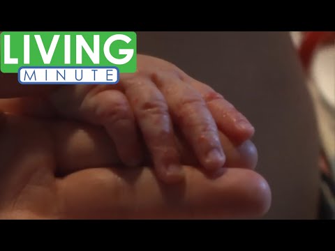 Is Hand Foot and Mouth Disease Contagious to Adults? | Living Minute