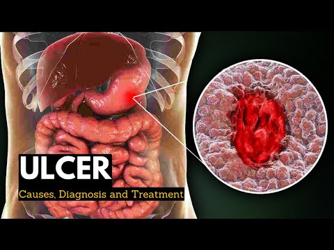 Ulcer, Causes, Signs and Symptoms, Diagnosis and Treatment.