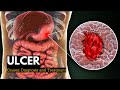 Ulcer, Causes, Signs and Symptoms, Diagnosis and Treatment.