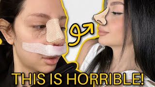 7 MONTH RHINOPLASTY NOSE JOB POST OP... I wish I never did it!!!