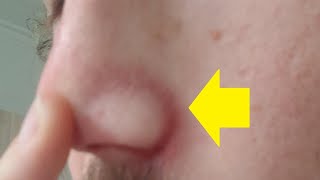 how to get rid of redness around nose crease fast