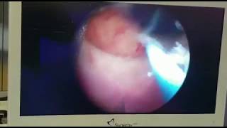 Uretrotomia endoscopica per stenosi dell'uretra