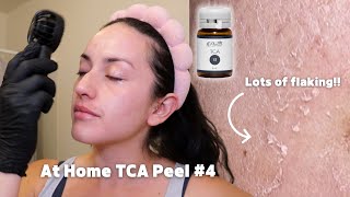 TCA 13% Peel for Acne Scars & Texture | Day-by-Day Peeling Results (At Home)