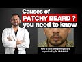 Patchy Beard Causes Solutions Treatments To Deal With Patchy Beard
