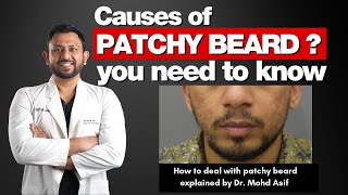 Patchy Beard Causes | Solutions | Treatments To Deal with Patchy Beard