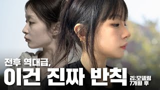 리;모델링ㅣ반응 폭발 이후… 7개월차 리얼 후기 공개ㅣ비티성형외과