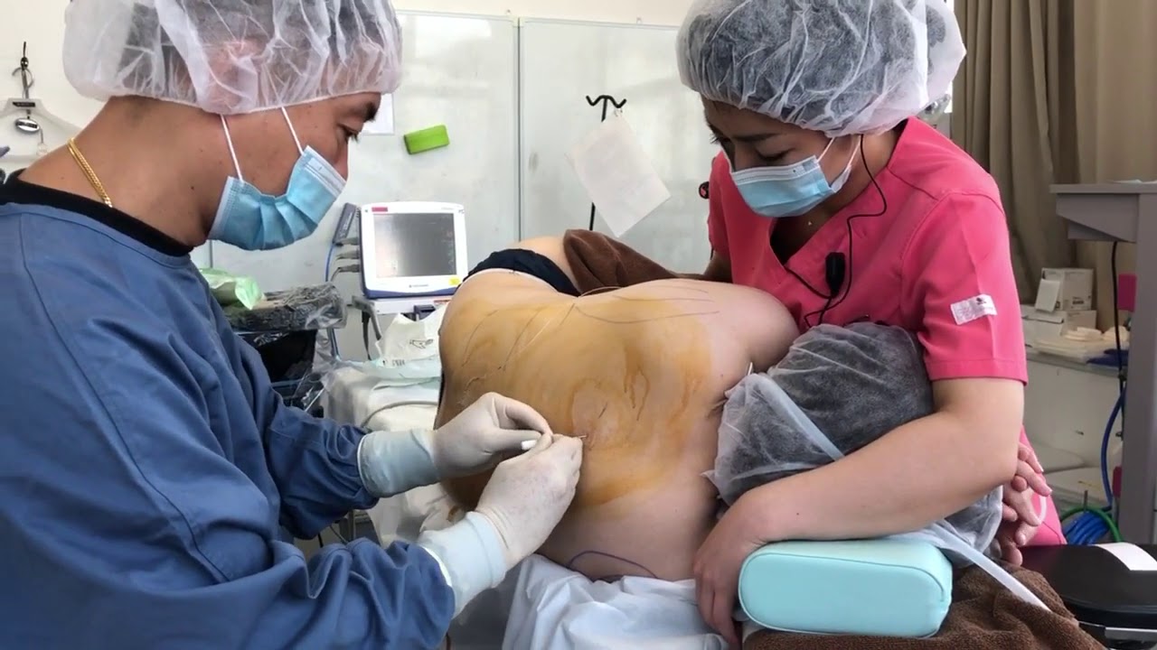 ジャケットを着た時にパツパツなので脂肪吸引をする！二の腕術中