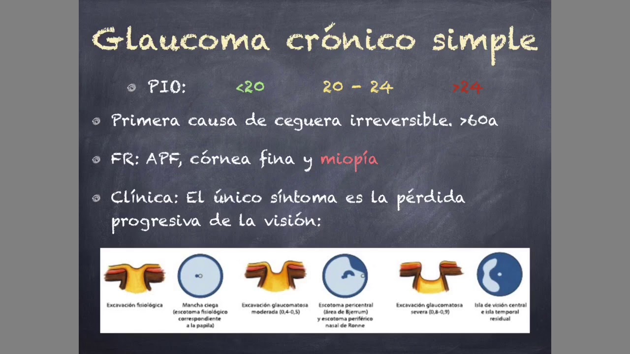 Glaucoma