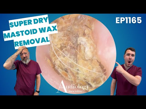 Extreme Dry Skin & Ear Wax in Mastoid Cavity Cleared! - EP1165